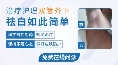 艾叶煮水洗澡能治白斑病吗