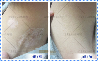 孩子患有白癜风能治好吗 一个疗程是多久
