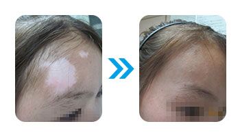 小孩子额头上长白斑是怎么了