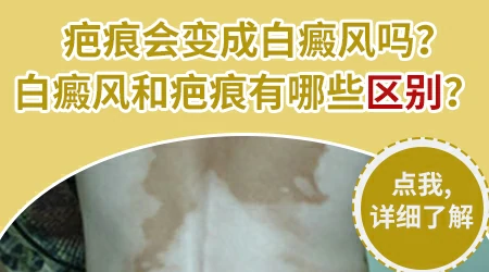三岁宝宝胳膊上有白斑和疤痕一样吗