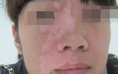 怀孕脸上突然出现白斑怎么回事