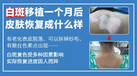 白癜风表皮移植手术一个月后没看到效果怎么办