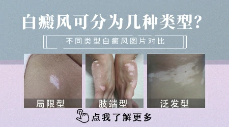 肢端型白癜风与节段性白癜风有什么区别