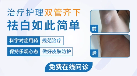 白癜风做308光疗中途中断会不会影响之前的效果