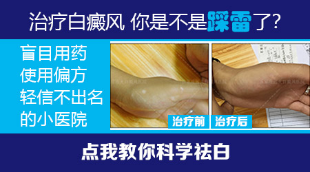白癜风是什么原因引起的 治白癜风难吗