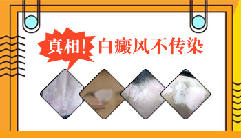 白癜风传染伴侣吗 白斑对生育有影响吗