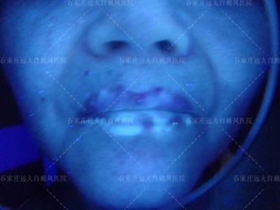 伍德灯下嘴唇白癜风图片