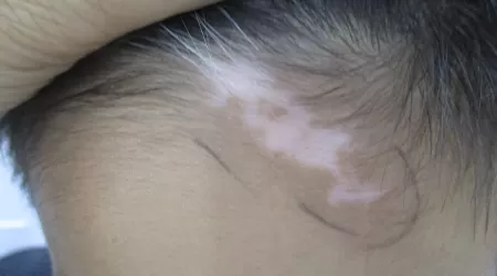 发际线有白斑怎么回事