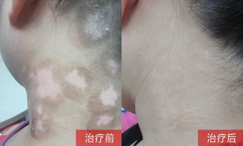 不同阶段的白癜风治疗应该怎么区分开