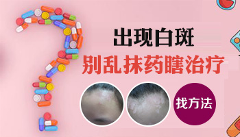 日本皮肤万能膏药能治好白癜风吗
