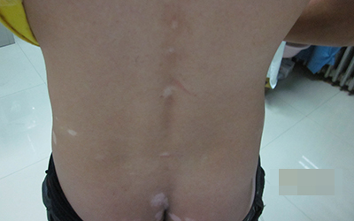 小孩后背有白斑图片 孩子长白斑的原因是什么