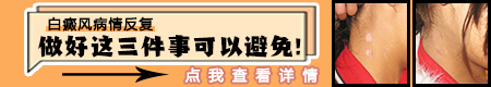 白癜风照uvb灯有效果吗 后期会反复吗
