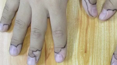 手指末梢皮肤发白怎么回事