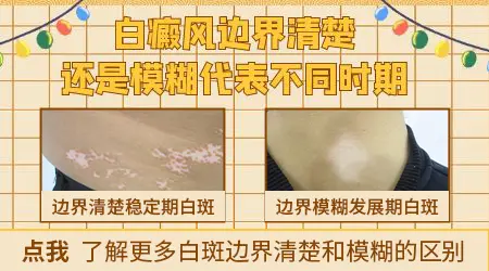白斑边界模糊和清晰各代表什么
