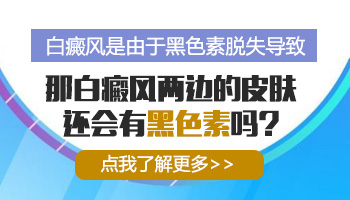 白斑病是怎么形成的 刚长出来的白斑是什么