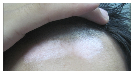 额头淡白色的白斑是不是白癜风怎么看