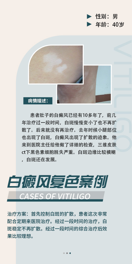 腿上胸前都有白斑什么情况 白斑会蔓延吗