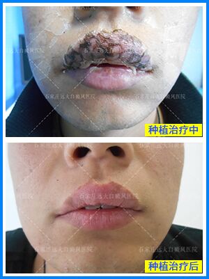 石家庄远大白斑医院能治好吗 石家庄治疗白癜风