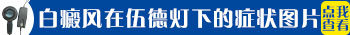 伍德灯下白斑边界清晰蓝白色是白癜风吗