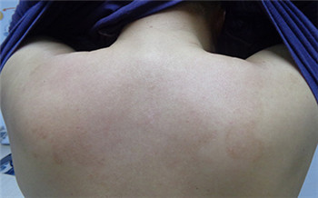 后背突然长白点是什么