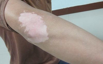 手臂上的白斑有一个月了有变大怎么回事