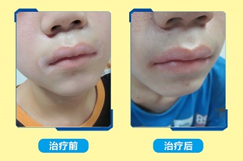 孩子嘴角有块白斑 白斑比以前大了怎么回事