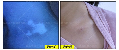 检查白斑好转经常照伍德灯有危害吗