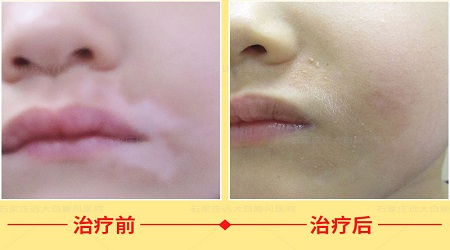 石家庄远大白斑医院能治好白癜风吗 白癜风康复案例