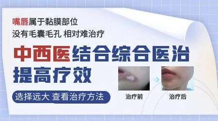 白癜风黏膜部位到底能不能治好