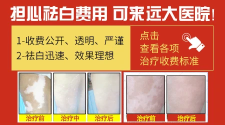 正规皮肤病医院看白斑多少钱