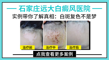 石家庄哪个医院的皮肤科比较好 哪家医院能治好白斑