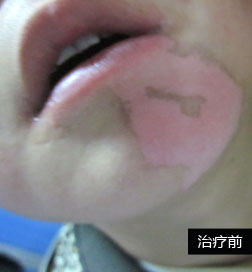 石家庄白癜风医院公益援助案例