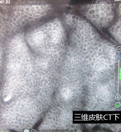 石家庄白癜风医院康复案例