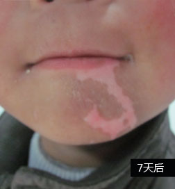 石家庄白癜风医院公益援助案例