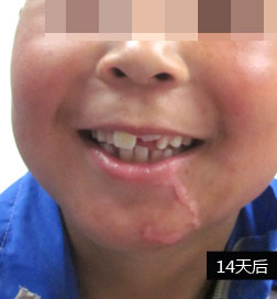 石家庄白癜风医院公益援助案例