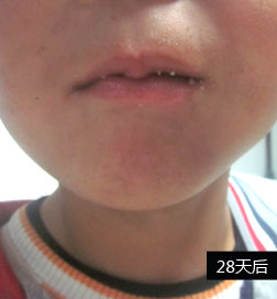 石家庄白癜风医院公益援助案例