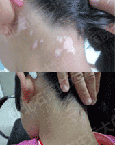 石家庄白癜风康复故事网友分享