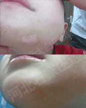 石家庄白癜风康复故事网友分享