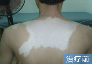 石家庄白癜风医院健康达人