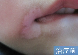 石家庄白癜风医院健康达人