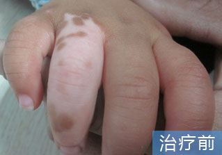 石家庄白癜风医院健康达人