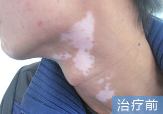 石家庄白癜风医院健康达人