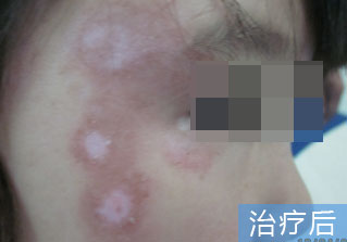 石家庄白癜风医院健康达人