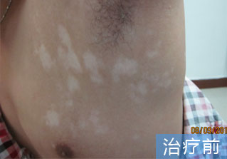 石家庄白癜风医院健康达人