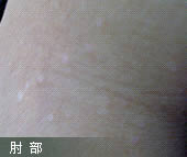 肘部