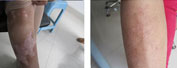 腿部白癜风治疗前后
