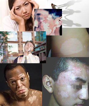 白癜风四大危害